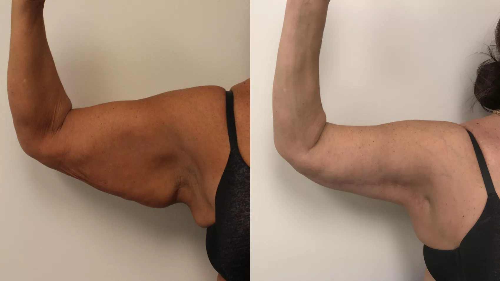 Brachioplasty: Your Right to Bare Arms