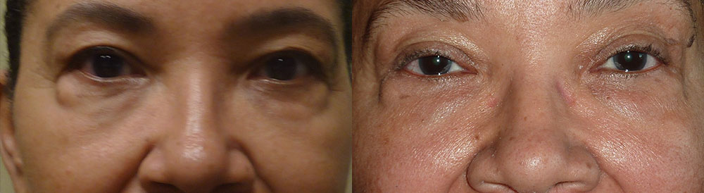 Eyelid Before and After