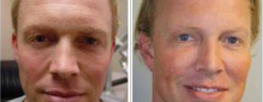 Before and After Dermal Fillers