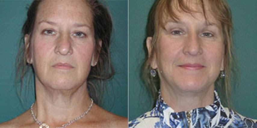 Facelifts Before and After