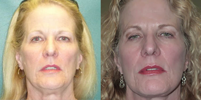Facelifts Before and After