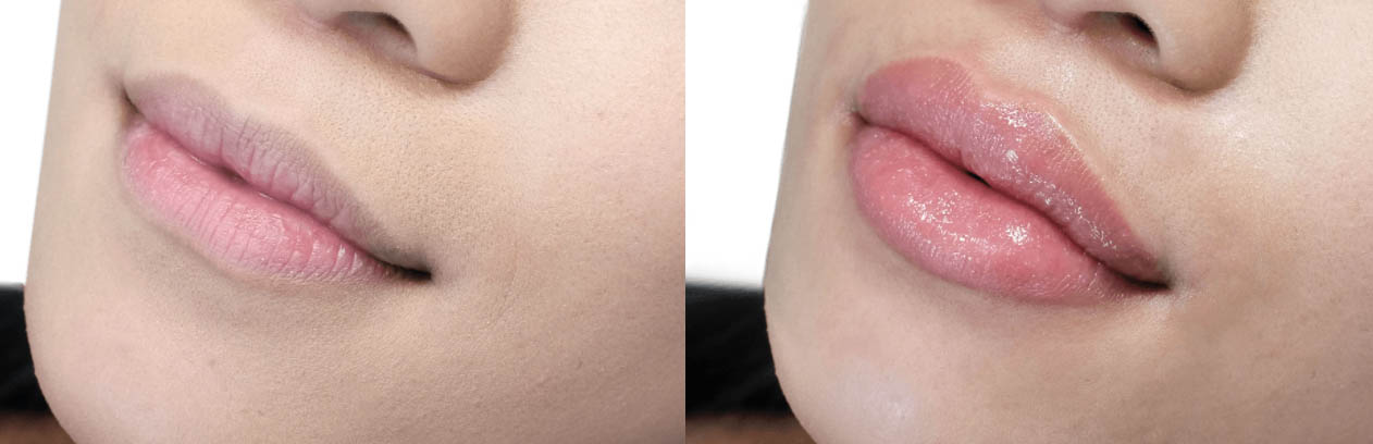 Lips Before and After