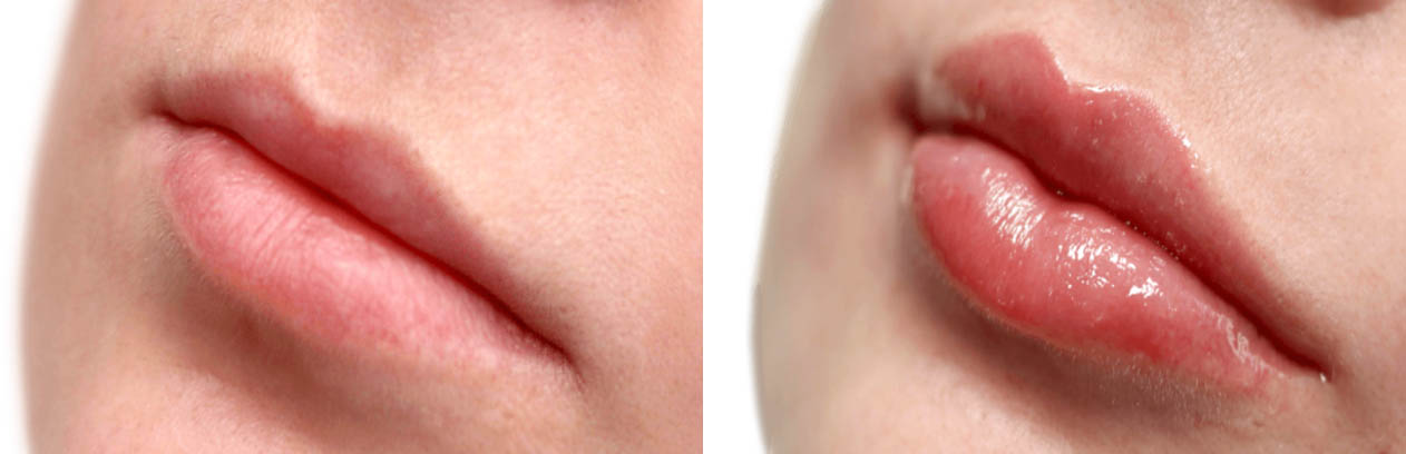 Lips Before and After