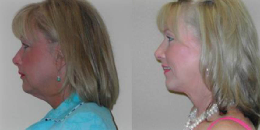 Minimally Invasive Before and After