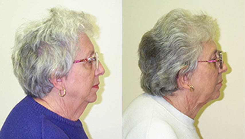 Neck Lifts Before and After