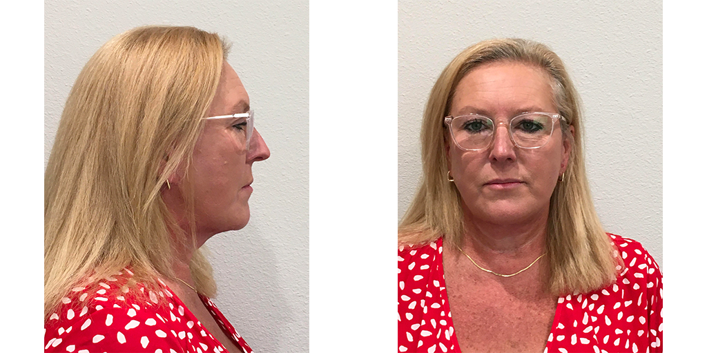 FACELIFT Before & After