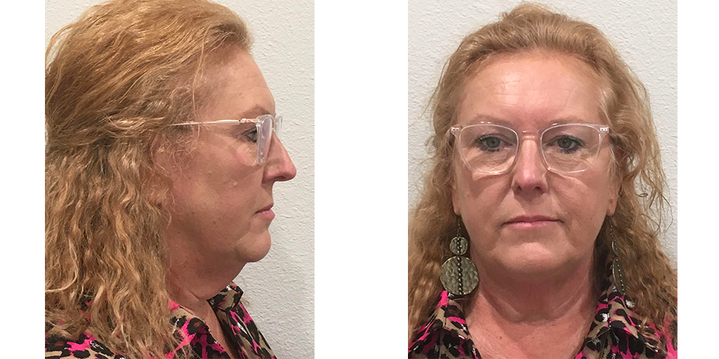 FACELIFT Before & After