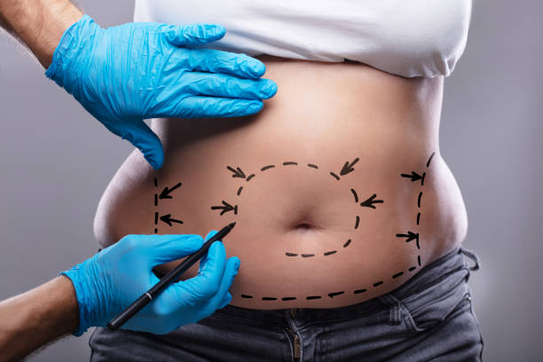 Best Surgeon for Your Tummy Tuck